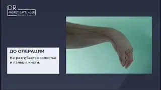 ЛУЧЕВОЙ НЕРВ. Лечение в нии микрохирургии, г. Томск