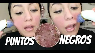 APARATO MILAGROSO para eliminar puntos negros