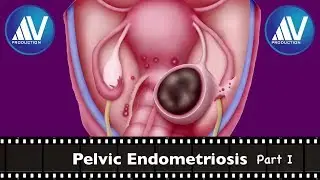 Pelvic Endometriosis Part I