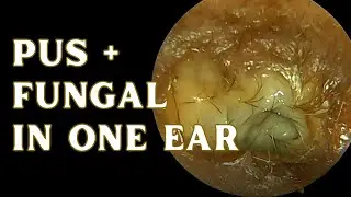 Pus and Fungal In The Same Ear !