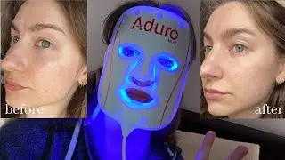 Aduro Light Therapy Mask Review + Results