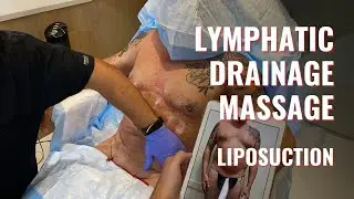 LYMPHATIC DRAINAGE MASSAGE TO SPEED HEALING AFTER FULL BODY MALE ATHLETIC LIPOSUCTION |DR JASON EMER