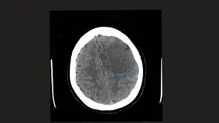 Cerebral Oedema; Cytotoxic or Vasogenic. Can you tell the difference?