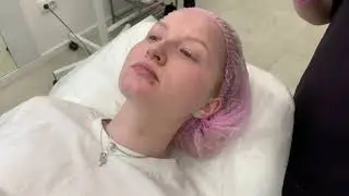 Консультация и контурная пластика губ