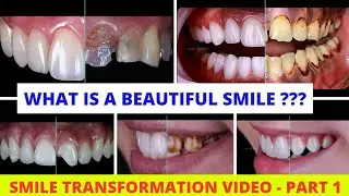 😍😍smile transformation befor and after time lapse | smile correction |  your dentist #smilemakeover