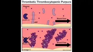 Thrombotic thrombocytopenic purpura (TTP)