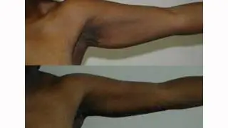 Armlift  | Reduce Excessive Skin | San Francisco Plastic Surgery