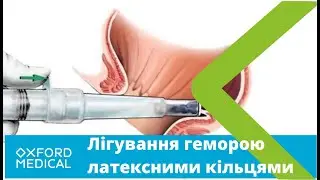 Як лікувати ГЕМОРОЙ без ОПЕРАЦІЇ? ЛІГУВАННЯ латексними кільцями