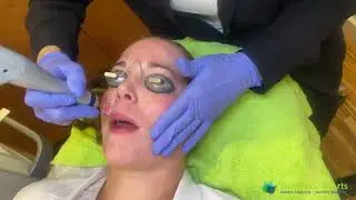 PicoWay Laser Facial in Seattle at Well Medical Arts
