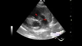 Pediatric Echocardiography - Floating Accessory Pulmonary Valve Tissue