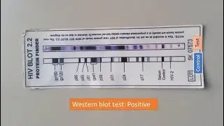 HIV အတည်ပြုစစ်ဆေးခြင်း (Confirmatory test: Western blot)