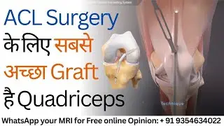 ACL Surgery के लिए सबसे अच्छा Graft है Quadriceps ! Best Tendon Graft for ACL Ligament Surgery
