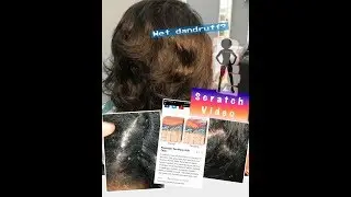 Scratching WET dandruff after a Relaxer (Plaque psoriasis) Extension removal