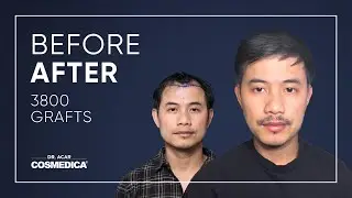 Hair Transplant in Turkey | Results | Dr. Acar | Cosmedica Clinic