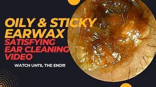 OILY & STICKY Earwax With SATISFYING Ear Cleaning Video