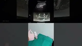 Sacroiliac joint injection