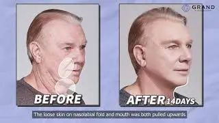 [Grand Plastic Surgery] All You Need to Know About Anti-aging Surgeries