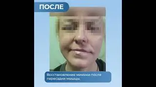 Лицевой паралич, лицевой нерв. Пересадка мышцы для восстановления улыбки. Результат