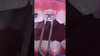 Is it painful to get braces on? - How braces are put on? Toothtime Family New Braunfels Texas