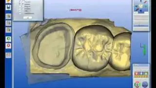 Cerec Back-up plan  Biogenerics vs Correlation