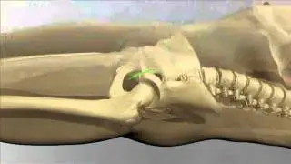 Anterior Approach Hip Replacement