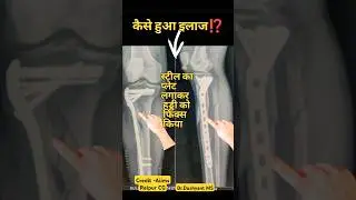 Leg Bone Fracture Treatment 🔥 टांग की हड्डी टूट गई ⁉️ #fracturerecovery #bonefracture #bonehealth