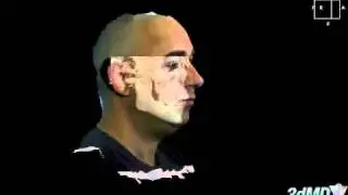 Before Jaw Surgery for Obstructive Sleep Apnea - 3D Imaging Software