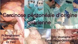 Carcinose péritonéale d'origine ovarienne sous coelioscopie