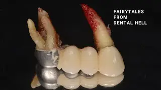 DENTAL BRIDGE REMOVAL #dentist #asmr