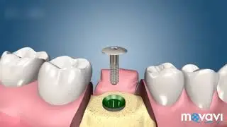 Двухэтапная имплантация зубов