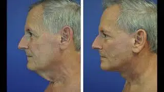 Mens Neck Lift | The Only HD Mens Neck Lift | HD Neck Lift by Dr. Andrew Ress