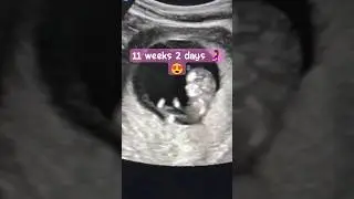 Ultrasound Scan Of 11 Week 2 days Old Fetus #shorts #babygirl #ultrasound
