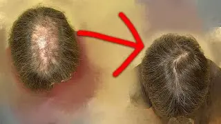 HOW YOU CAN REGAIN HAIR WITHOUT A TRANSPLANT