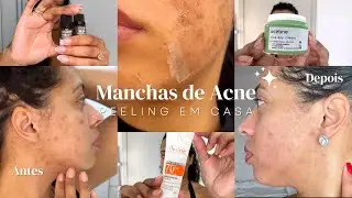 Como tirar manchas de acne do rosto com PEELING QUÍMICO + Atualizações da minha pele