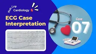 ECG Case Interpretation | Chest Pain | Myocardial Infraction | Heart Attack | Abnormal ECG | Case 07