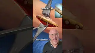 Ankle Fracture Surgical 🔪Repair 