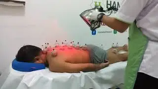 Bekam yang higienis dan professional oleh Klinik Hamdalah Makassar