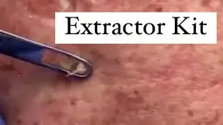 How to remove blackheads!  Comedone Extractor Tools