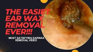 The EASIEST Ear Wax Removal EVER!
