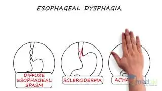 Gastroenterology - Dysphagia: By Samantha Gray M.D.