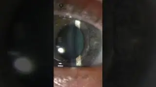 Iris Claw Lens Implant