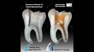UltraCal™ XS placement and removal with Citric Acid 20%