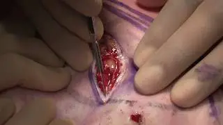 Ultrasound wire guided wide local excision and sentinel node biopsy