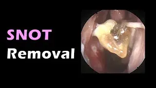 BIG nose snot removal