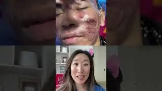 #acne