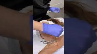 Advanced Chemical Peel | Face, Chest, Neck