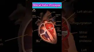 Mitral Valve Prolapse #shorts #heart