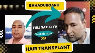 Hair Transplant In Bahadurgarh | Hair Transplant In India