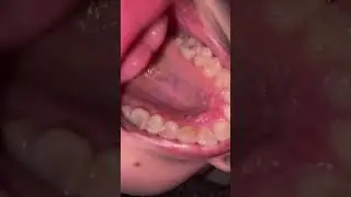 Mouth Tour  Uvula and Teeth