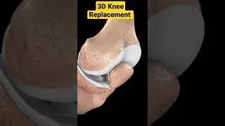 3D Knee Replacement Animation✓✓• 